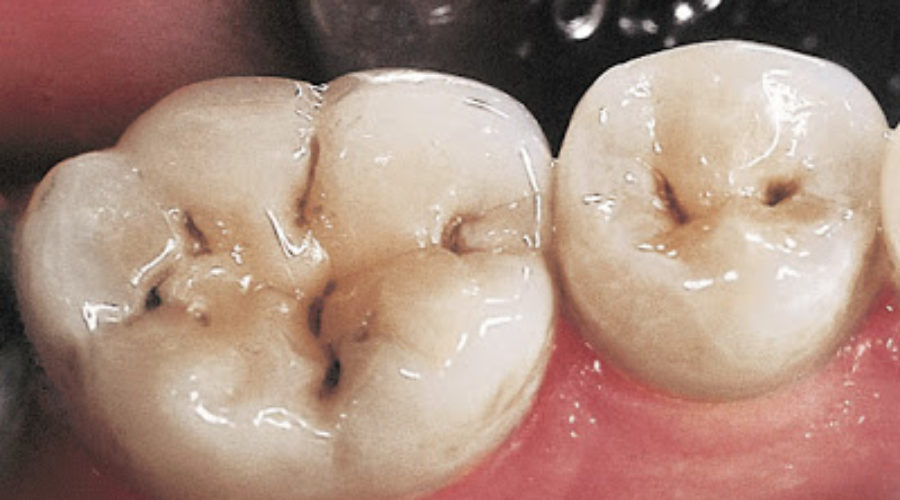 Dental Caries – A Disease!